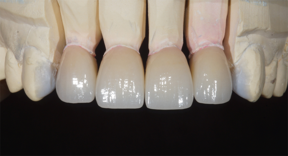 Виниры керамические Emax фото передних зубов Alex Mart
