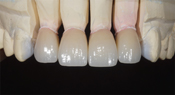 Виниры керамические Emax фото передних зубов.